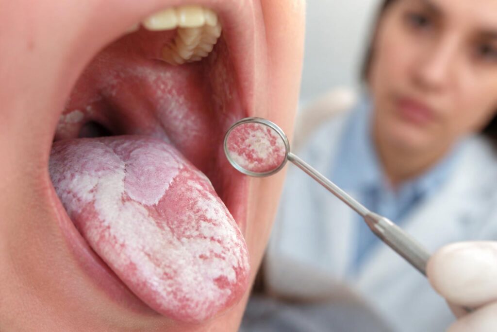 découvrez comment reconnaître rapidement les symptômes du muguet pour agir efficacement et prévenir les complications liées à cette infection courante.